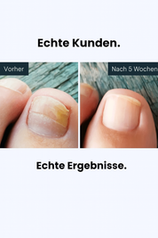 Vira Antifungal Stift - 25% Undecylensäure